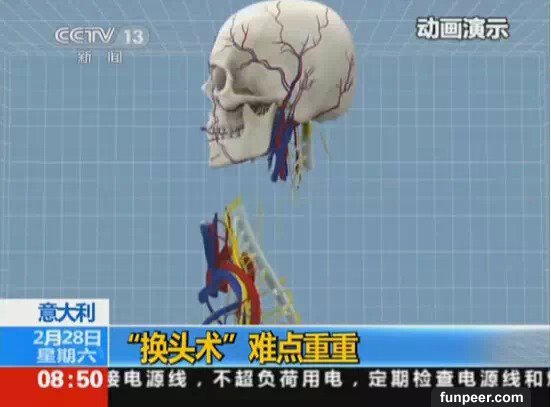 震撼 | 男子將接受世界首例換頭手術,砍下頭然後對換?